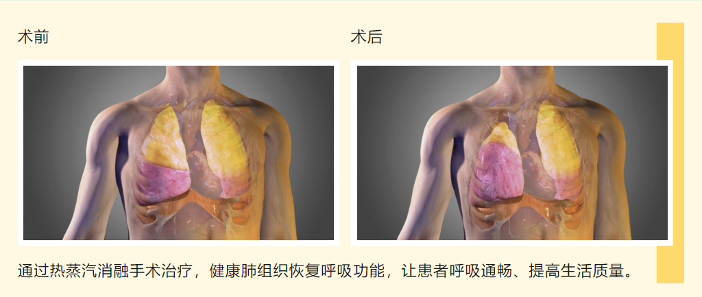 支氣管鏡“蒸汽盾”激活肺動力——湖北省第三人民醫(yī)院開展靶向熱蒸汽消融術，讓慢阻肺患者告別“窒息人生”